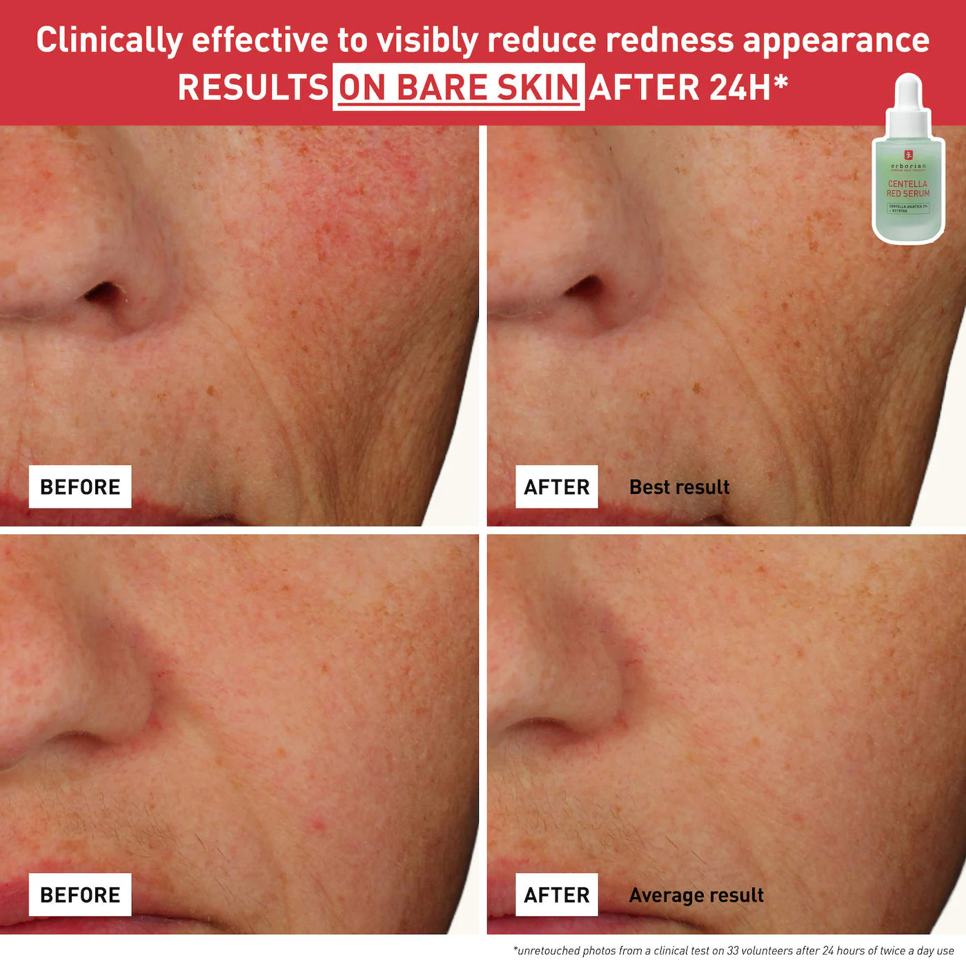 *PREORDEN: Centella Red Serum for Visible Redness & Immediate Soothing Effect on Sensitive Skin - Erborian / Sérum de Centella Roja para piel sensible