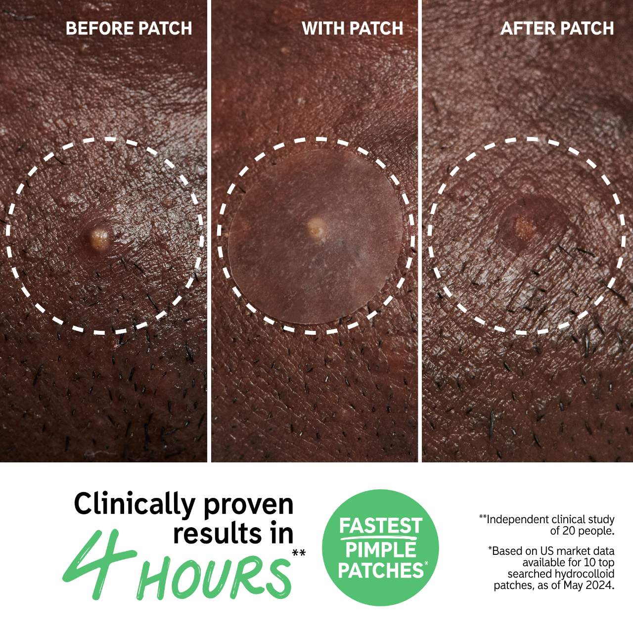 *PREORDEN:Hydrocolloid Invisible Pimple Patches - The inkey list / Parches para granitos