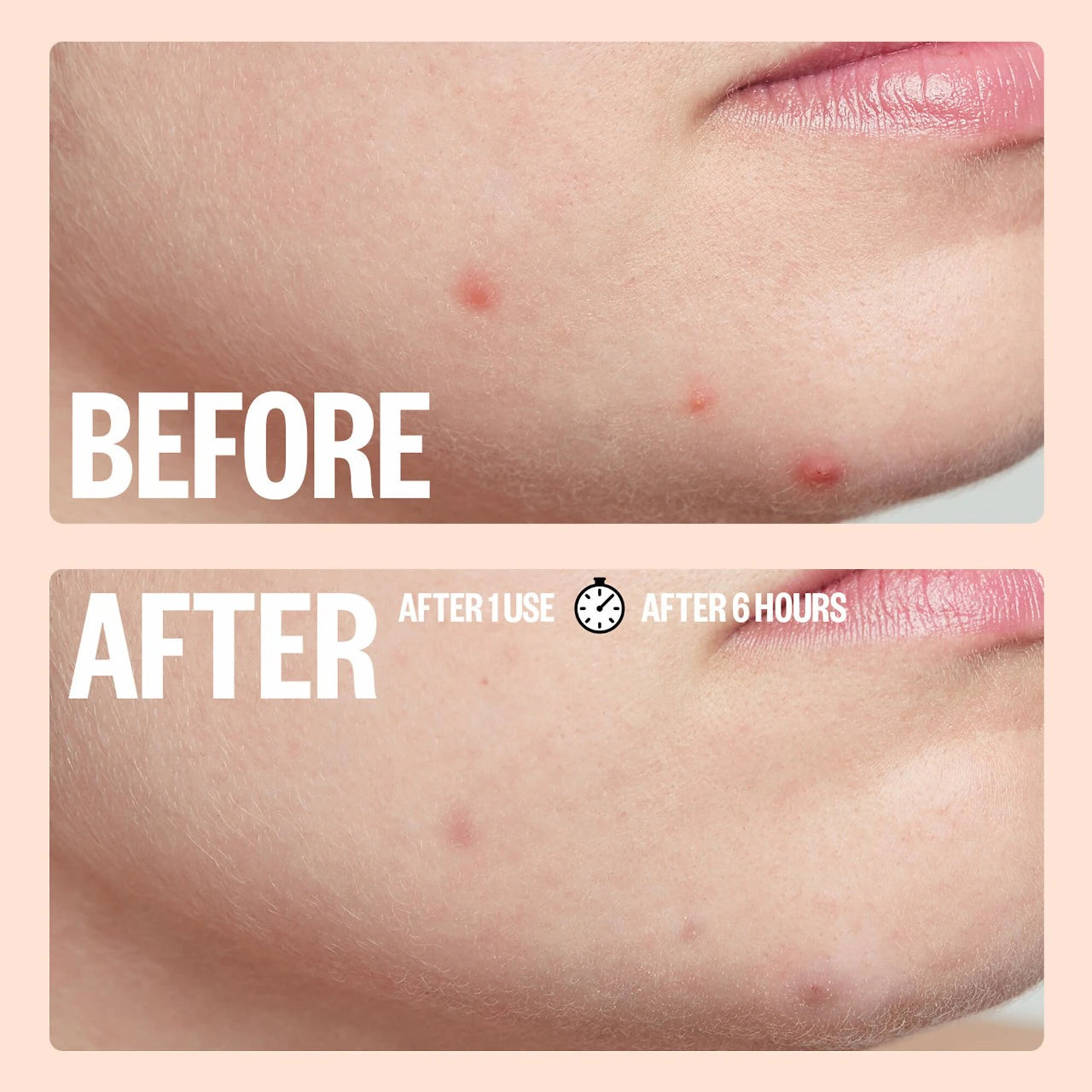 *PREORDEN: Salicylic Acid Acne Healing Dots - Peace Out / Parché para ácne