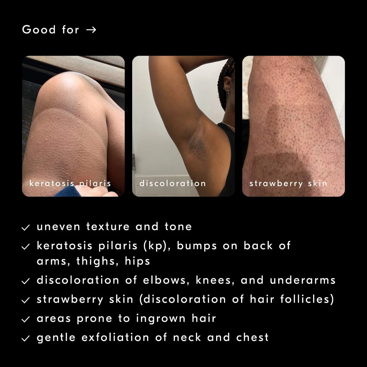 *PREORDEN: Smoothing Solution AHA Chemical Peel Body Exfoliator - Soft Services / Gel exfoliante corporal para tratar queratosis pilaris