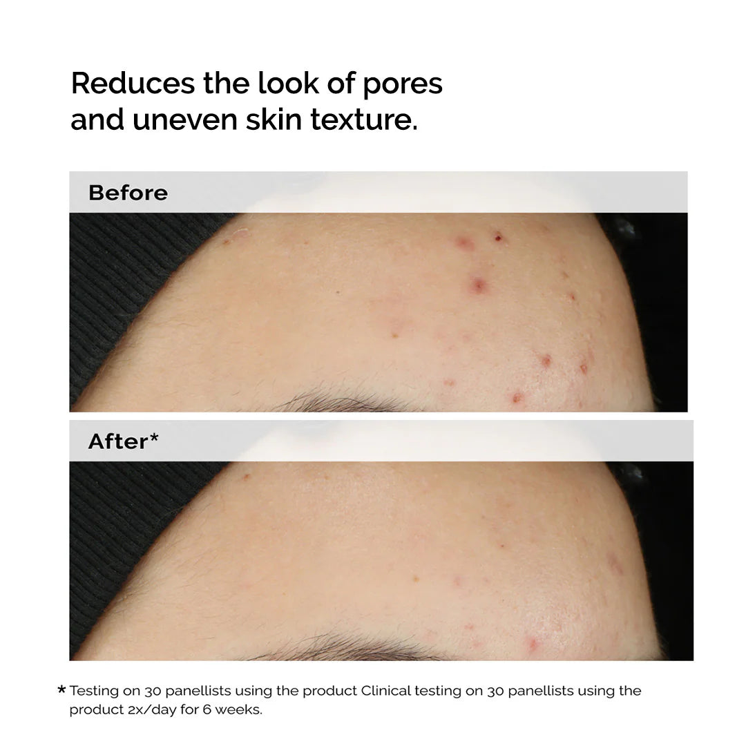 Balancing & Clarifying Serum for Blemish-Prone Skin - The Ordinary / Suero para poros y brillo