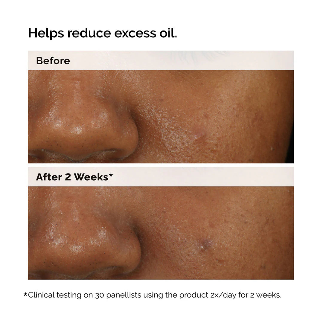 Balancing & Clarifying Serum for Blemish-Prone Skin - The Ordinary / Suero para poros y brillo