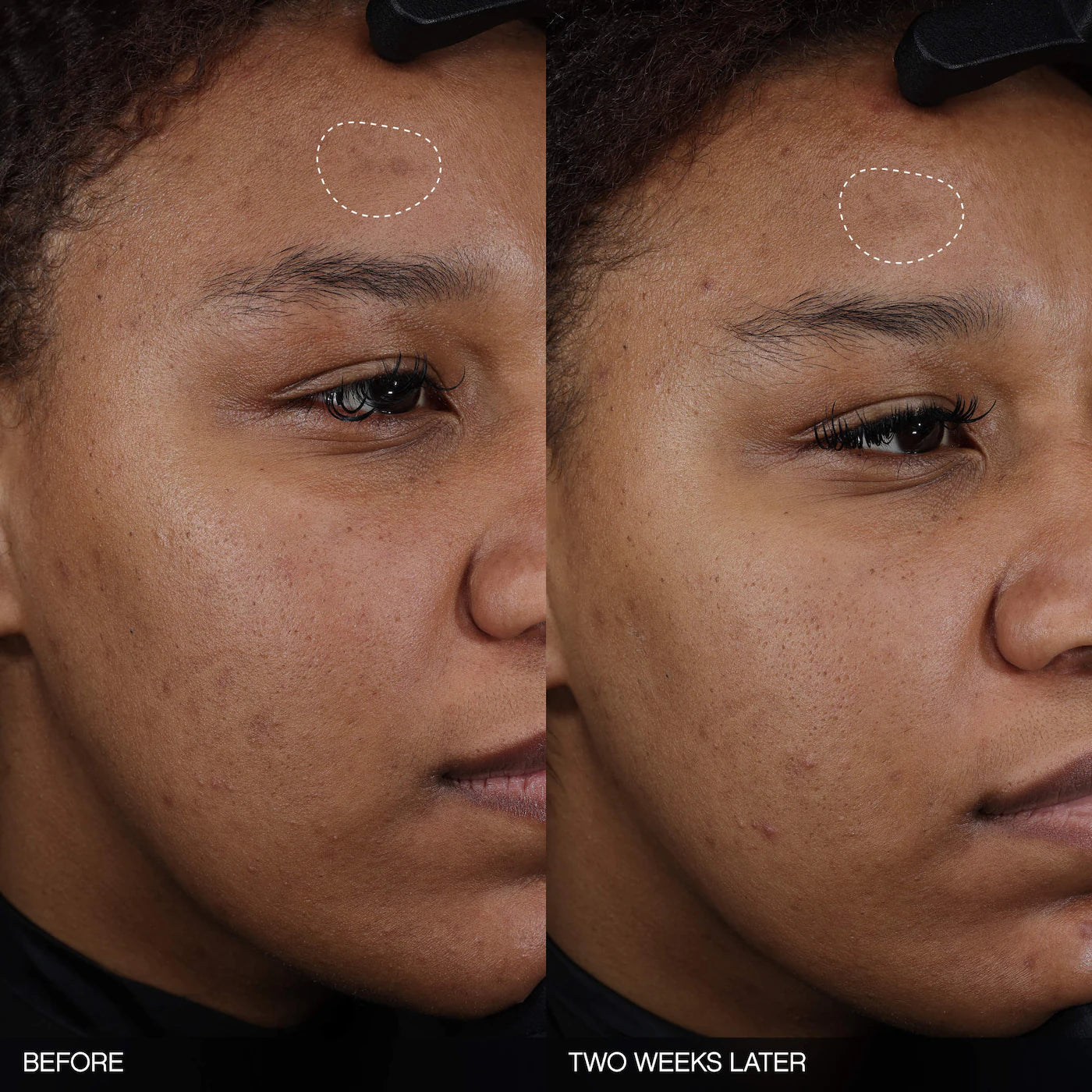 *PREODEN: Faded Tranexamic Acid Dark Spot Patches for Hyperpigmentation - Topicals / Parches para el ácne