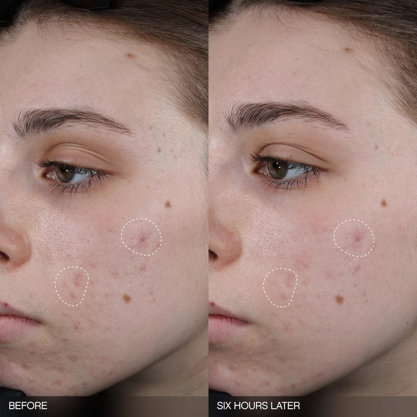 *PREODEN: Faded Tranexamic Acid Dark Spot Patches for Hyperpigmentation - Topicals / Parches para el ácne