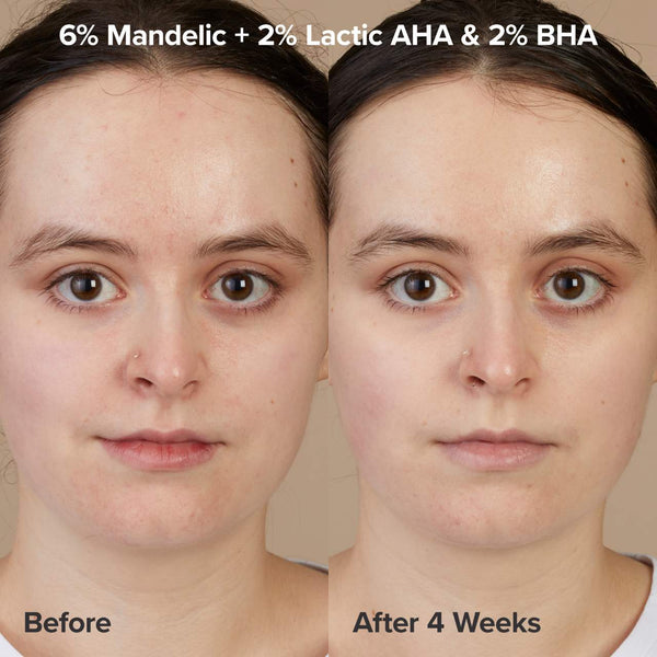 The Exfoliation Experience Kit with 2% BHA + 6% Mandelic Acid AHA - Paula’s Choice / Kit acné, poros, puntos negros, textura.