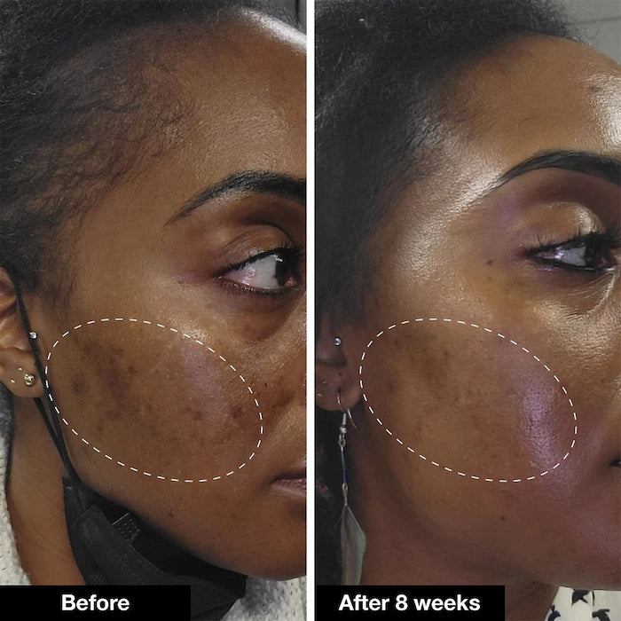 Retinol Remix 1% Retinol Treatment - iNNBEAUTY PROYECT / Arrugas, hiperpigmentación y poros