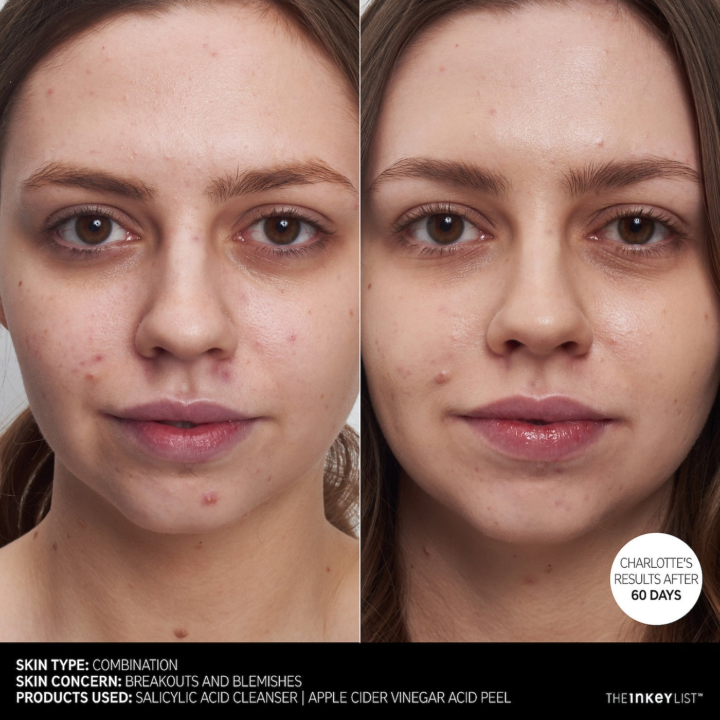 *PREORDEN: Salicylic Acid Acne + Pore Cleanser (BHA) - The Inkey List / puntos negros, poros y acné