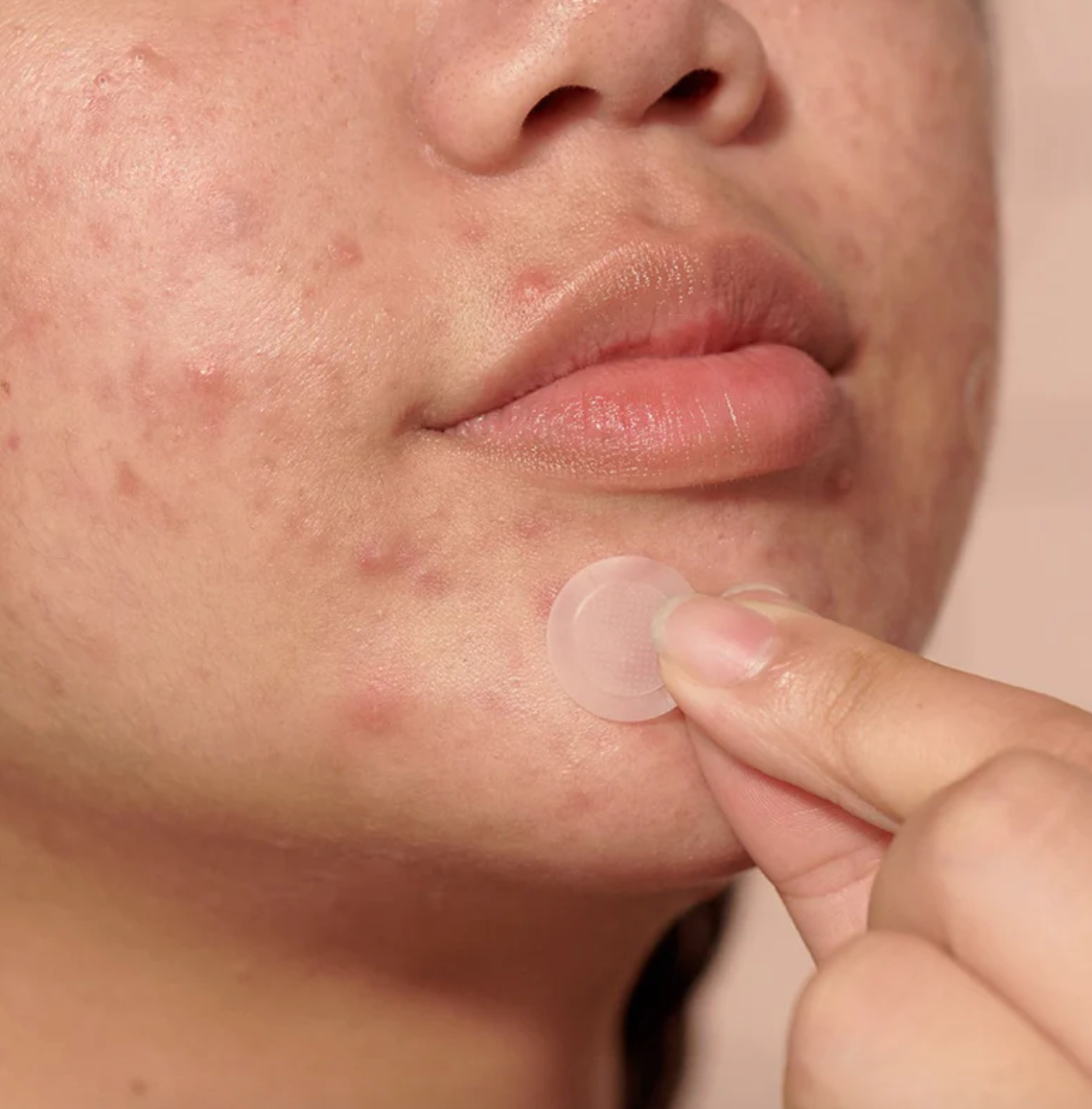 *PREORDEN: Micropoint for Blemishes - Hero / Parche para acné en etapa temprana