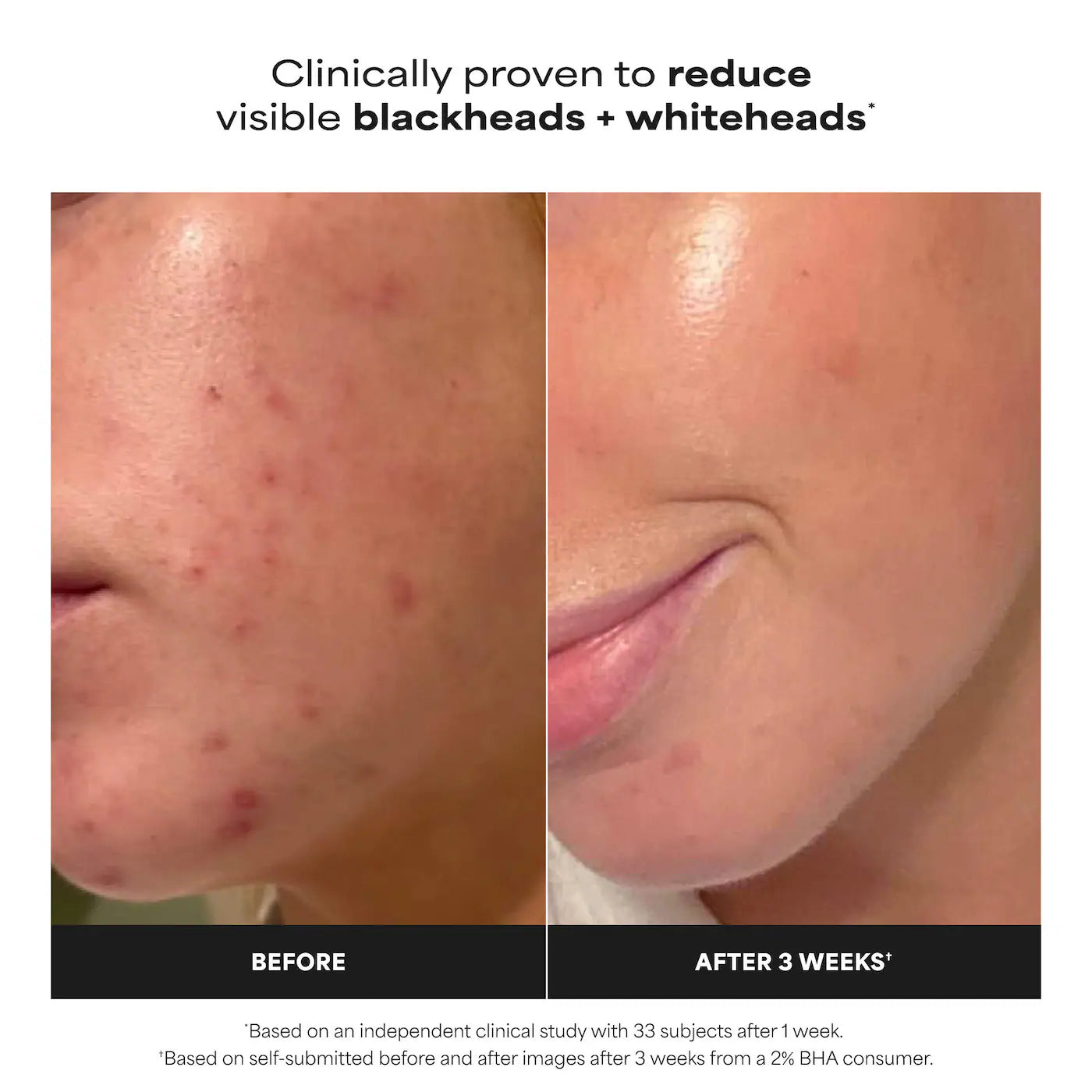 *PREORDEN: Home & Away Kit with 2% BHA Exfoliating Toner & Toner Pads for Clear Skin - Paula’s Choice / Acné, poros, puntos negros, textura