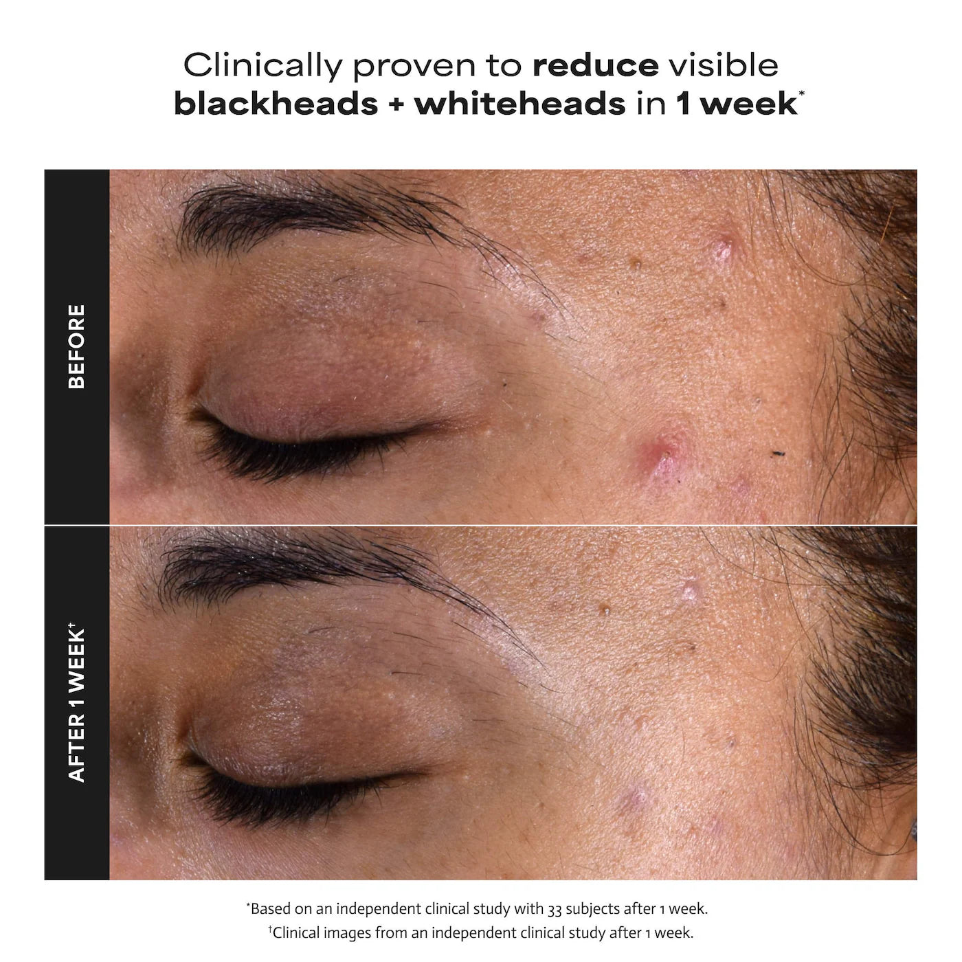 *PREORDEN: Home & Away Kit with 2% BHA Exfoliating Toner & Toner Pads for Clear Skin - Paula’s Choice / Acné, poros, puntos negros, textura