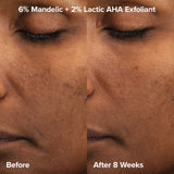*PREORDEN: Expert Exfoliation Kit with 2% BHA + 6% Mandelic Acid AHA - Paula’s Choice / Kit acné, poros, puntos negros, textura.