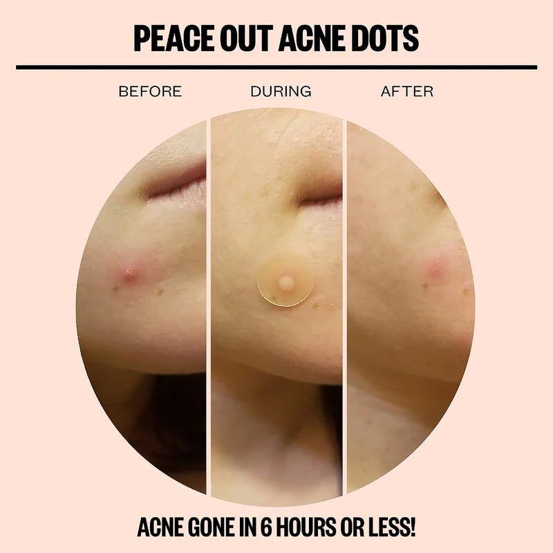 *PREORDEN: Salicylic Acid Acne Healing Dots - Peace Out / Parché para ácne