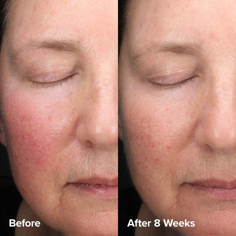*PREORDEN: Skin Perfecting 6% Mandelic Acid + 2% Lactic Acid Liquid Exfoliant - Paula’s Choice / Imperfecciones, arrugas, acné y poros.