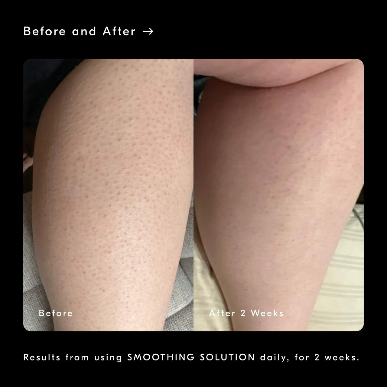 *PREORDEN: Smoothing Solution AHA Chemical Peel Body Exfoliator - Soft Services / Gel exfoliante corporal para tratar queratosis pilaris