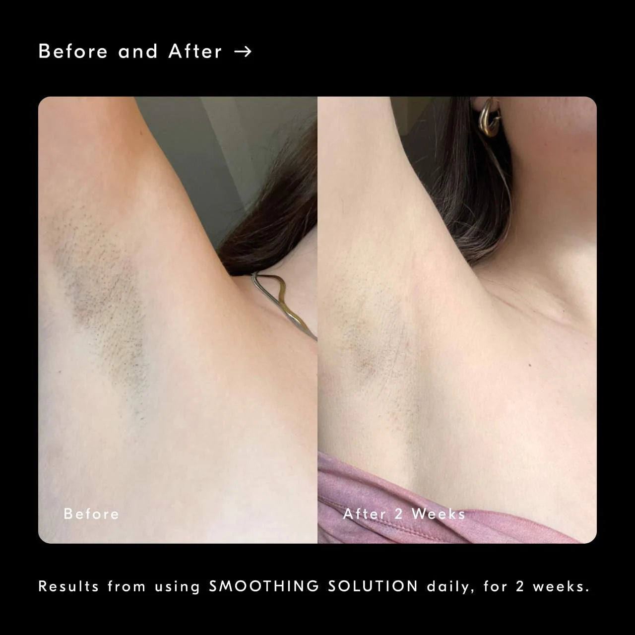 *PREORDEN: Smoothing Solution AHA Chemical Peel Body Exfoliator - Soft Services / Gel exfoliante corporal para tratar queratosis pilaris