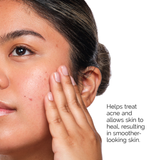 The Acne Set - The Ordinary / Set para piel con tendencia acné