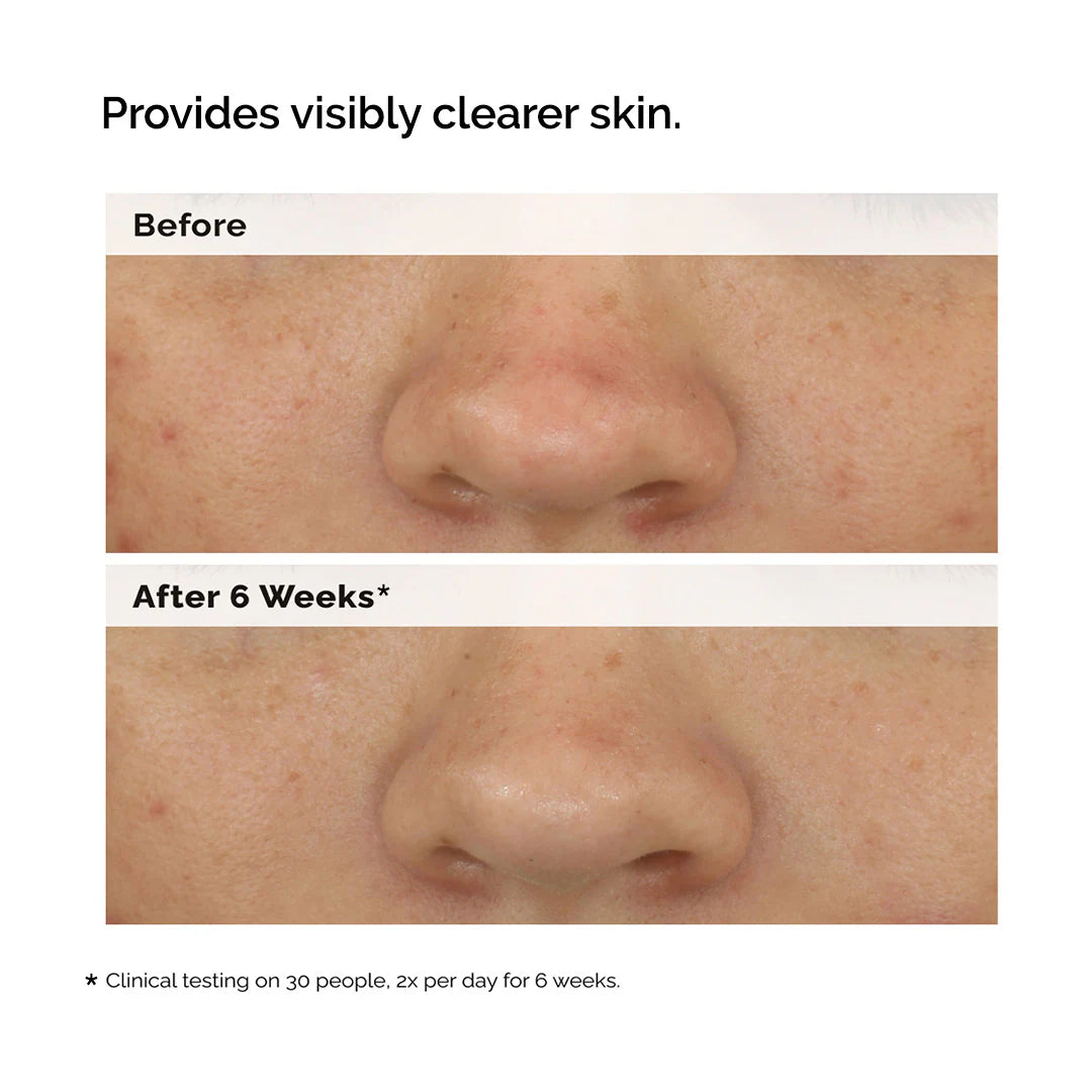 Balancing & Clarifying Serum for Blemish-Prone Skin  - The Ordinary / Suero para poros y brillo