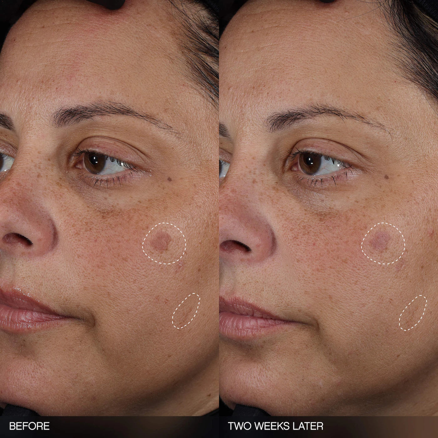 *PREODEN: Faded Tranexamic Acid Dark Spot Patches for Hyperpigmentation - Topicals / Parches para el ácne