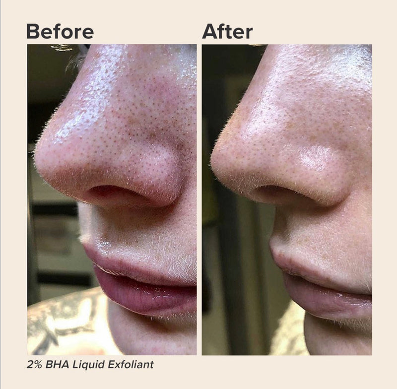 *PREORDEN: 2% BHA Liquid Exfoliant - Paula’s Choice / Acné, poros, puntos negros, textura.
