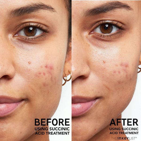 Succinic Acid Acne Treatment - The Inkey List / Tratamiento para el acné