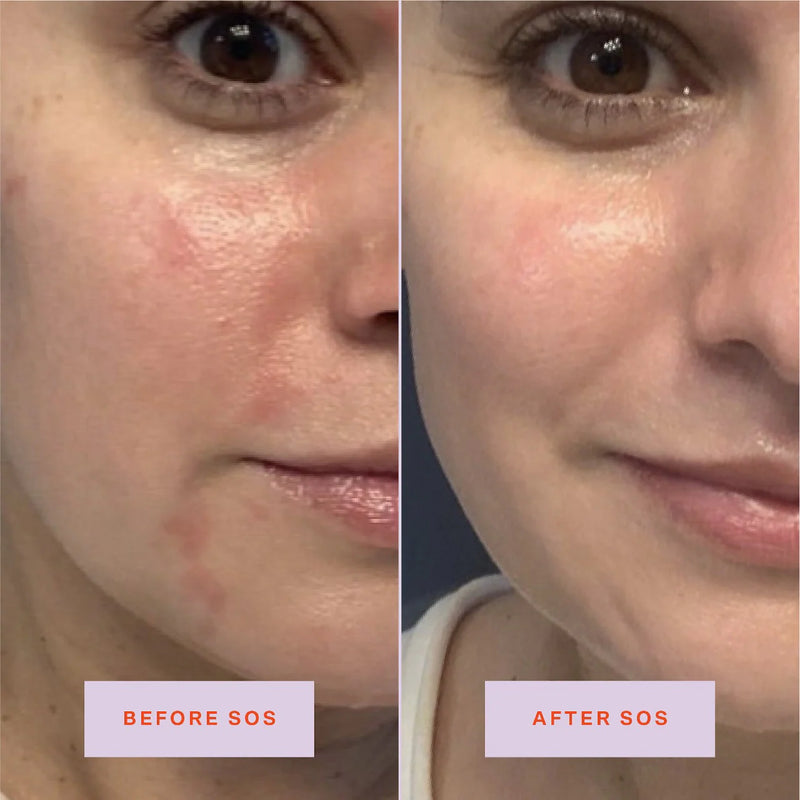 SOS Daily Rescue Facial Spray - Tower 28 / Minimiza acné, irritación y enrojecimiento